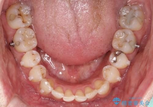 八重歯をインビザラインで矯正　大人の目立たない矯正の治療中