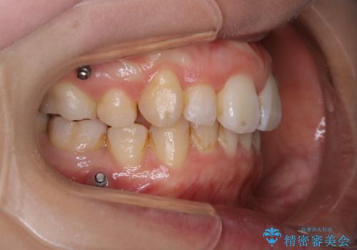 インビザラインの新しいマウスピースが届く前にクリーニング(アタッチメントが外れている時に)の治療前