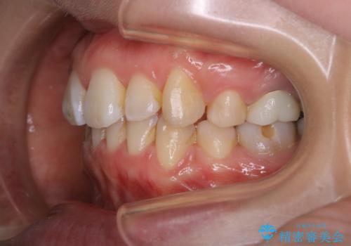 インビザラインの新しいマウスピースが届く前にクリーニング(アタッチメントが外れている時に)の治療前