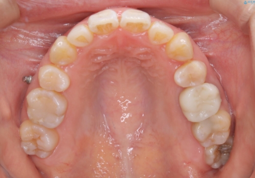 インビザラインの新しいマウスピースが届く前にクリーニング(アタッチメントが外れている時に)の治療前