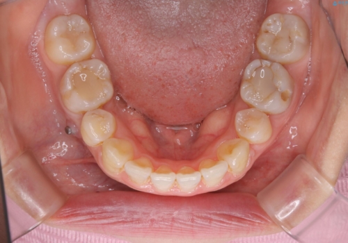 インビザラインの新しいマウスピースが届く前にクリーニング(アタッチメントが外れている時に)の治療前