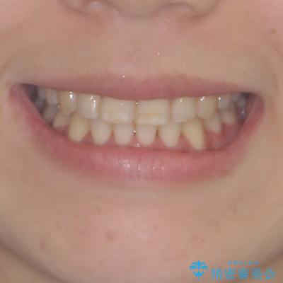 前歯のデコボコを短期間で解消　ワイヤー装置による抜歯矯正の治療後（顔貌）