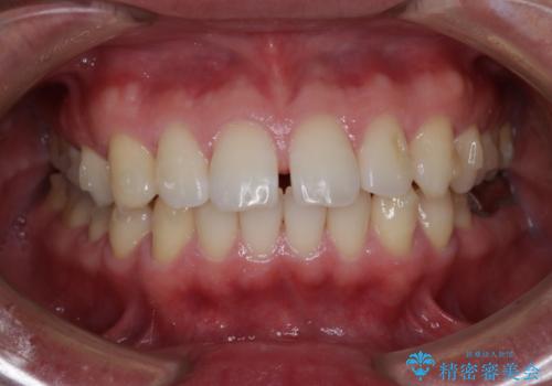 インビザライン・ライトで”すきっ歯と出っ歯”を改善の治療中