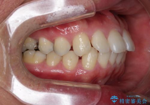 インビザライン・ライトで”すきっ歯と出っ歯”を改善の治療中