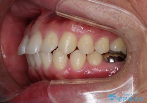 インビザライン・ライトで”すきっ歯と出っ歯”を改善の治療中