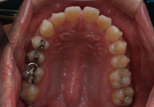 インビザライン・ライトで”すきっ歯と出っ歯”を改善の治療中