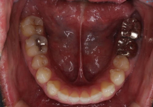 インビザライン・ライトで”すきっ歯と出っ歯”を改善の治療中