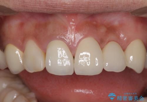 以前治療した歯が続々とむし歯に 全顎むし歯治療の治療後