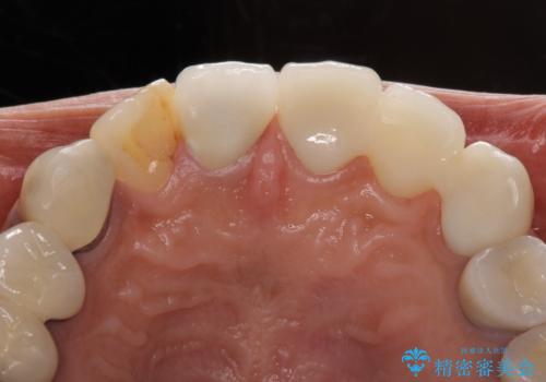 以前治療した歯が続々とむし歯に 全顎むし歯治療の治療後