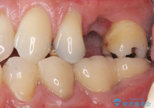 ソケットリフト 骨が薄い上の奥歯のインプラント 50代男性の治療前