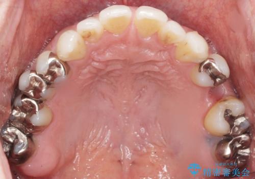 ソケットリフト　骨が薄い上の奥歯のインプラント　50代男性の治療前