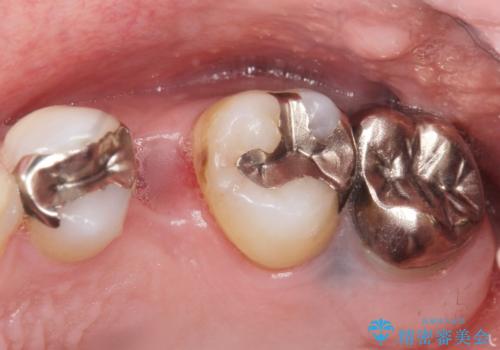 ソケットリフト　骨が薄い上の奥歯のインプラント　50代男性の治療前