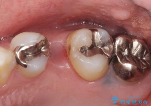 銀の詰め物を白くしたい 50代男性の治療前