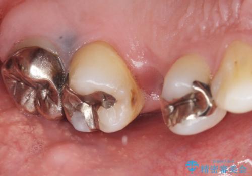 ソケットリフト 骨が薄い上の奥歯のインプラント 50代男性の治療前