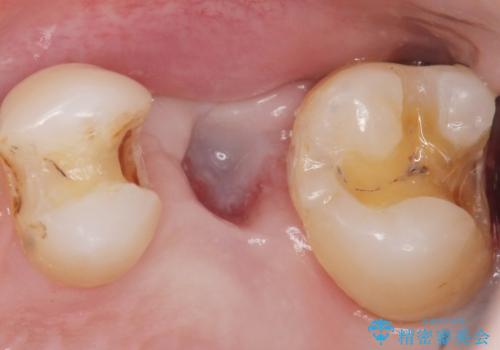 銀の詰め物を白くしたい 50代男性の治療中