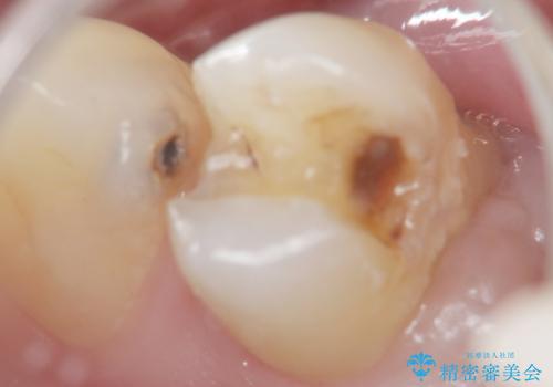 銀の詰め物を白くしたい 50代男性の治療中