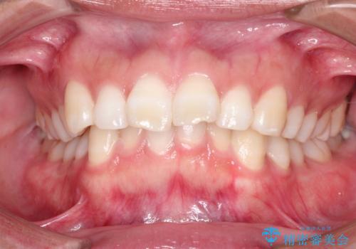 出っ歯の矯正 ワイヤーによる抜歯矯正での改善の治療前