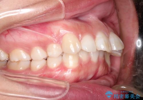 出っ歯の矯正　ワイヤーによる抜歯矯正での改善の症例 治療前