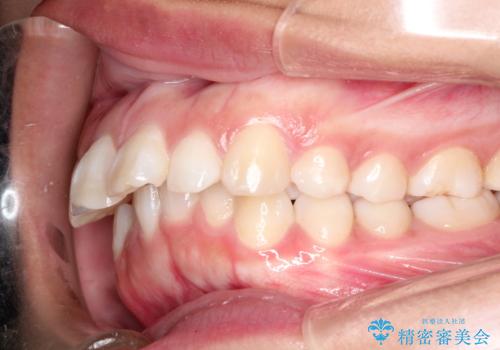 出っ歯の矯正　ワイヤーによる抜歯矯正での改善の治療前