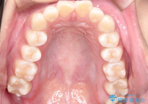 出っ歯の矯正　ワイヤーによる抜歯矯正での改善の治療前