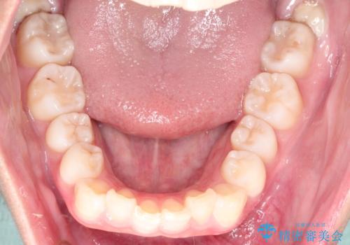 出っ歯の矯正 ワイヤーによる抜歯矯正での改善の治療前