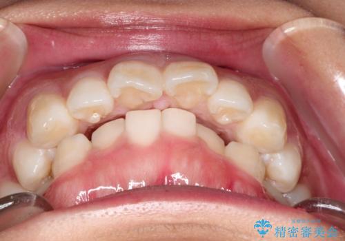出っ歯の矯正 ワイヤーによる抜歯矯正での改善の治療前