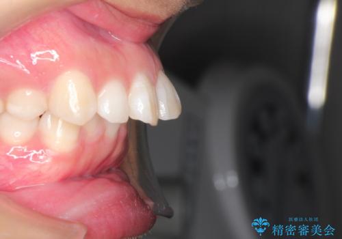 出っ歯の矯正 ワイヤーによる抜歯矯正での改善の治療前