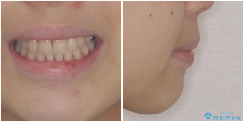 突出した口元が気になる ハーフリンガル装置による抜歯矯正の治療後(顔貌)