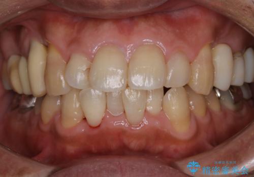 50代男性 1年ぶりにPMTC 前歯をきれいにの治療後