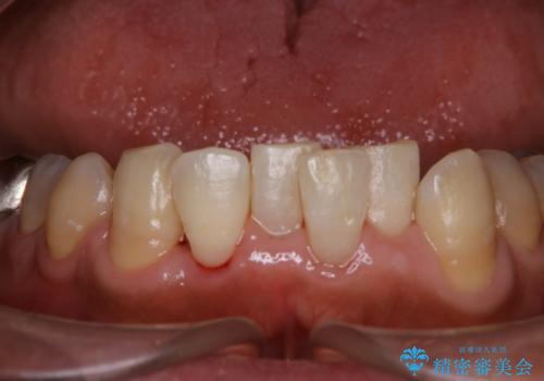 50代男性 1年ぶりにPMTC 前歯をきれいにの治療後