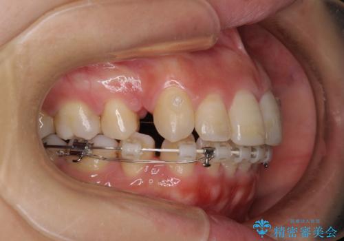 突出した口元が気になる ハーフリンガル装置による抜歯矯正の治療中