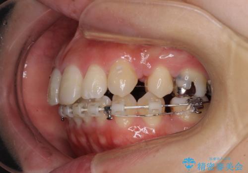 突出した口元が気になる ハーフリンガル装置による抜歯矯正の治療中