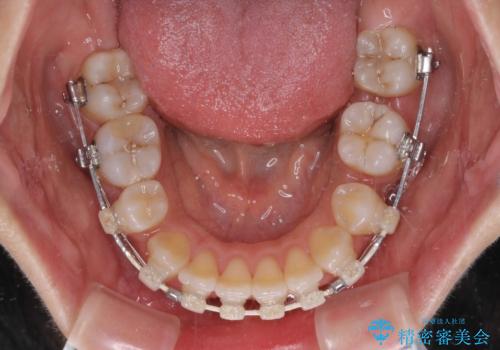 突出した口元が気になる ハーフリンガル装置による抜歯矯正の治療中
