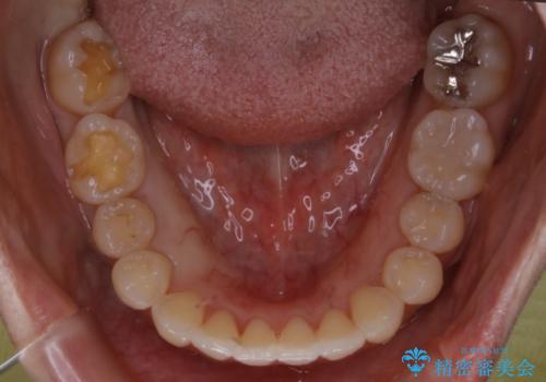 銀歯を白くしたい:矯正後に綺麗なセラミックへの治療中