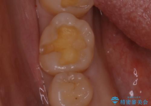 銀歯を白くしたい:矯正後に綺麗なセラミックへの治療中