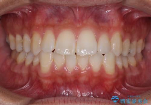 値段を抑えて歯列を整える インビザライン・ライトによる矯正治療の症例 治療前
