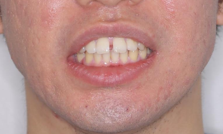 インビザライン・ライトで”すきっ歯と出っ歯”を改善の治療前（顔貌）