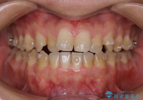 インビザラインで矯正治療中のクリーニング(PMTC)の治療前