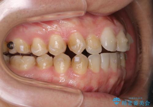 インビザラインで矯正治療中のクリーニング(PMTC)の治療前