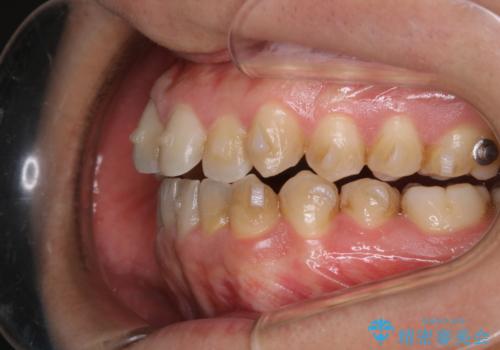 インビザラインで矯正治療中のクリーニング(PMTC)の治療前