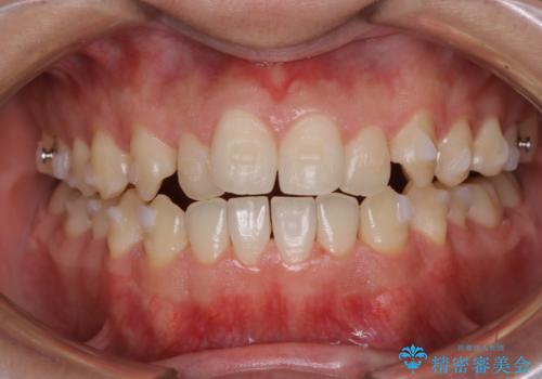 インビザラインで矯正治療中のクリーニング(PMTC)