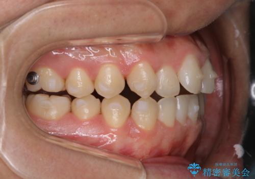 インビザラインで矯正治療中のクリーニング(PMTC)の治療後