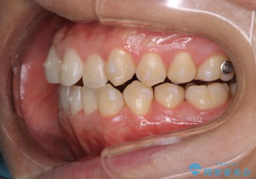 インビザラインで矯正治療中のクリーニング(PMTC)の治療後