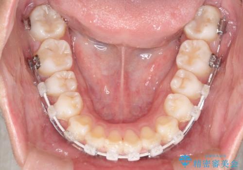 出っ歯の矯正 ワイヤーによる抜歯矯正での改善の治療中