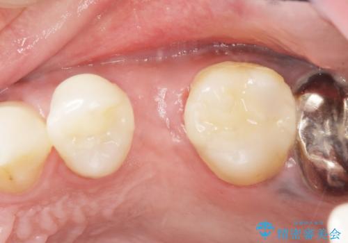 銀の詰め物を白くしたい 50代男性の治療後