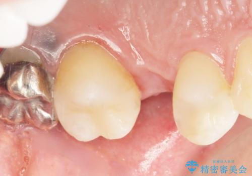 銀の詰め物を白くしたい 50代男性の治療後