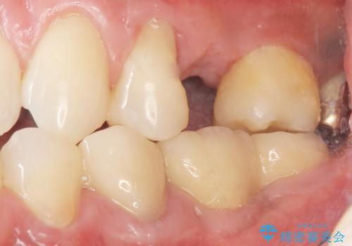 銀の詰め物を白くしたい 50代男性の治療後