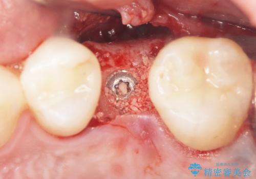 ソケットリフト　骨が薄い上の奥歯のインプラント　50代男性の治療中