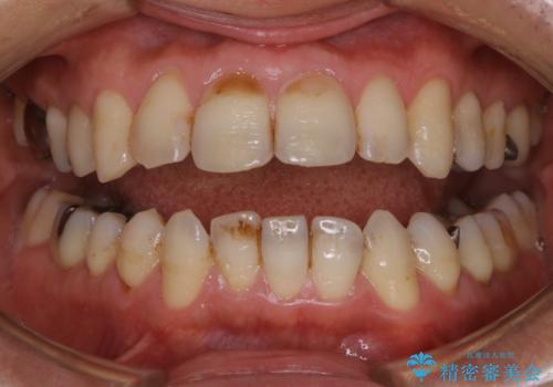 虫歯や歯周病予防のためにクリーニングを(PMTC)の治療前