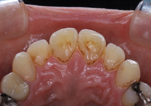 虫歯や歯周病予防のためにクリーニングを(PMTC)の症例 治療前